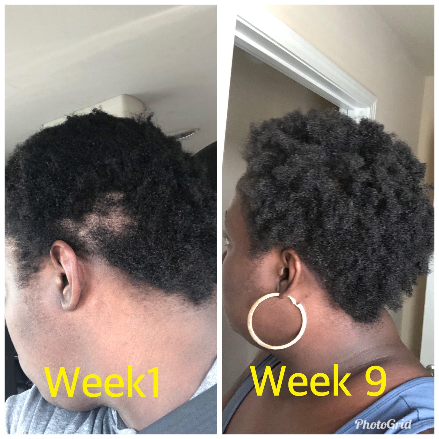 hair growth oil for thinning hair for all hair types kinky curly hair Before and after hair growth