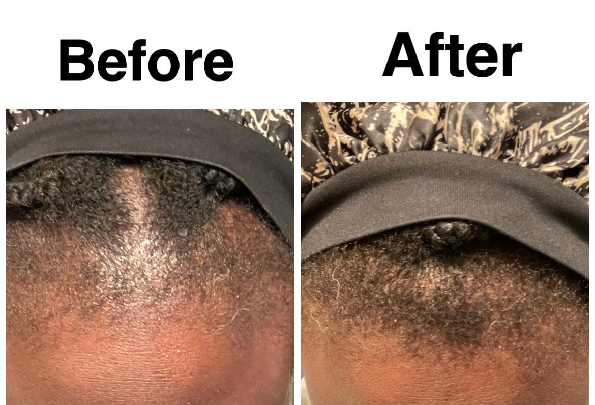 alopecia in growth hair receding hairline hair falling out baldness balding men baldness in women balding head baldness cure bald hair