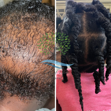 Load image into Gallery viewer, Before and after of toddler with hair loss in back of head 
