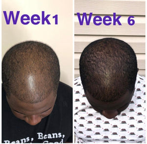 alopecia in growth hair receding hairline hair falling out baldness balding men baldness in women balding head baldness cure bald hair