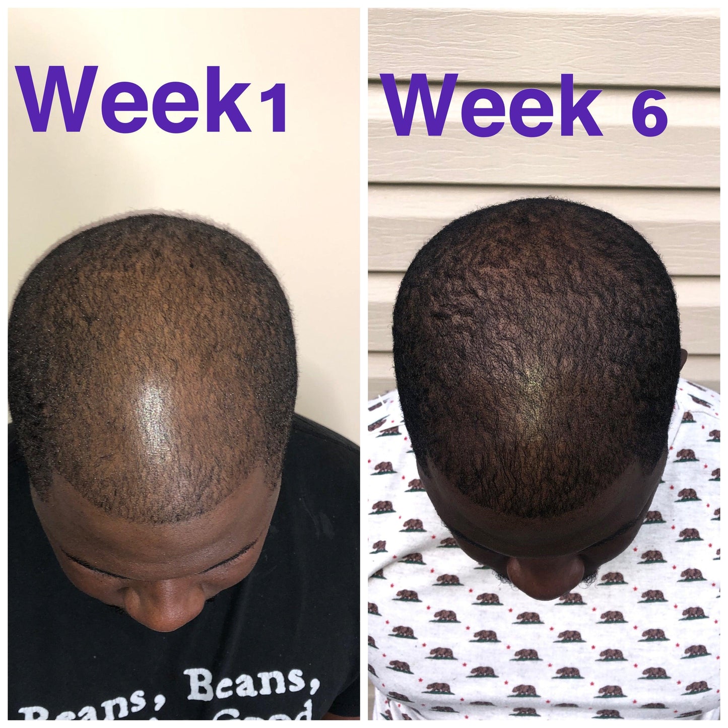 men hair growth oil for all types balding thinning hair before and after receding hair line