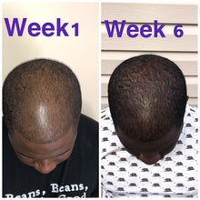 Load image into Gallery viewer, men hair growth oil for all types balding thinning hair before and after receding hair line
