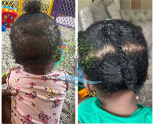 Hair growth before and after after using the east of eden natural Antibreakage hair growth butter, for balding, thinning hair growth treatment the works