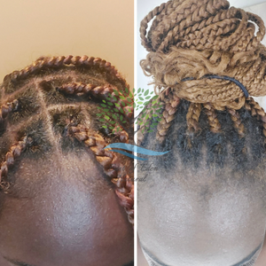 Before and After of hair growth transformation-alopecia in growth hair receding hairline hair falling out baldness balding men baldness in women balding head baldness cure bald hair